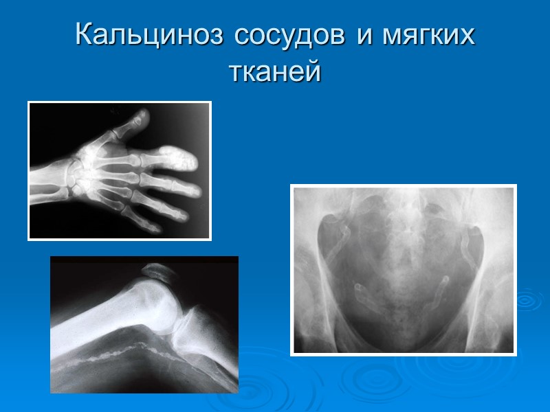 Кальциноз сосудов и мягких тканей